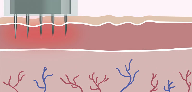 kosmetolog Kielce wykonują zabieg depilacji laserowej twarzy